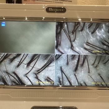 Scalp Bar - Before (bottom) and after (top right) of my scalp - Blow Dry/Out Services Near Me - Las Vegas, Nevada Scalp Bar - Before (bottom) and after (top right) of my scalp - Blow Dry/Out Services Near Me - Las Vegas, Nevada