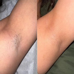 The Waxing Studio - Before and after underarm waxing