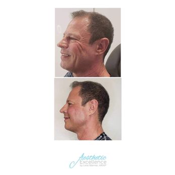 Livia Manner FNP - Before and after Fillers, better than 10 yrs ago - Medical Spas Near Me - Hollywood, Florida Livia Manner FNP - Before and after Fillers, better than 10 yrs ago - Medical Spas Near Me - Hollywood, Florida