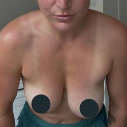 Christine Fisher MD, FACS - Uneven breasts