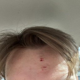 Heres what his head looks like after getting hit with the umbrella.