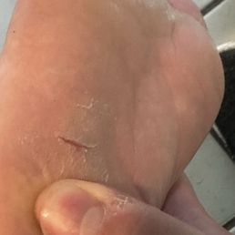 Cut foot and dry skin. Cut foot and dry skin.