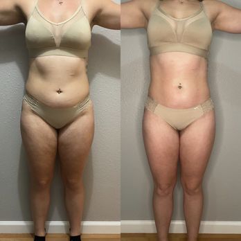 Modern Body Contour - Body Contouring Near Me - Sacramento, California Modern Body Contour - Body Contouring Near Me - Sacramento, California