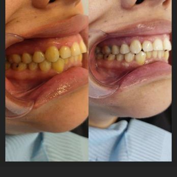 Smile Start - My before and after - Cosmetic Dentists Near Me - Los Angeles, California