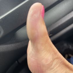 Platinum Nails - Callused toe