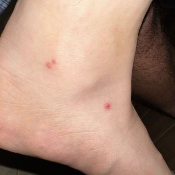 Avi Resort & Casino - Bed bug bite #2/3 - Casinos Near Me - Laughlin, Nevada Avi Resort & Casino - Bed bug bite #2/3 - Casinos Near Me - Laughlin, Nevada