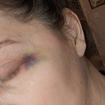 Beaux MedSpa - it was way worse in person  and stayed for 3 weeks, this is not the work of a professional!!!  Beware of this place.  Look at the injectors - Medical Spas Near Me - Austin, Texas