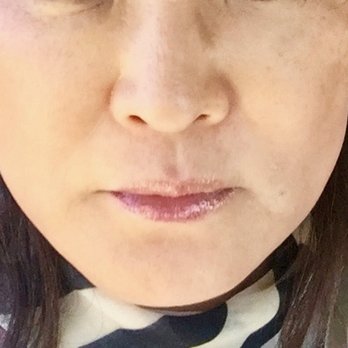 Donald W Lee, MD - After - Cosmetic Surgeons Near Me - Los Angeles, California Donald W Lee, MD - After - Cosmetic Surgeons Near Me - Los Angeles, California