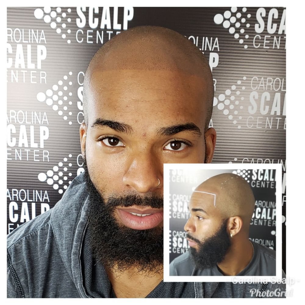 CAROLINA SCALP CENTER/SCALP MICROPIGMENTATION 12 Photos 743 W
