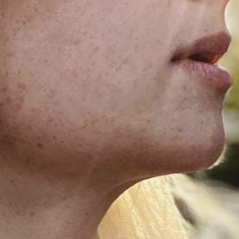 Wellspring Plastic Surgery - After - Plastic Surgeons Near Me - Austin, Texas