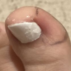 Nail Studio II - Infection, drew a line around the redness. throbbing pain.
