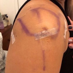 Kyle F Chun, MD - 1 day post op!