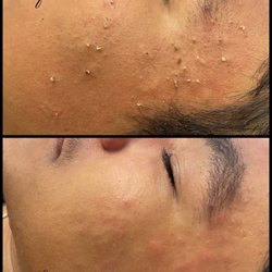 Detox Facial includes extractions