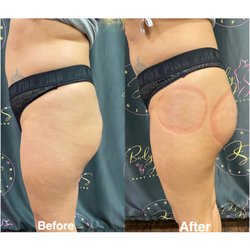 Body By J&S - Buttock enhancement