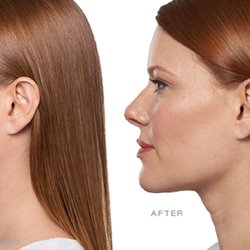 Mays Dermatology & Cosmetic Center - KYBELLA® contours and improves the appearance of moderate to severe submental fullness, sometimes referred to as a "double chin.