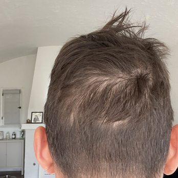 Barber Surgeons Guild - Results of hair transplant from June 2023 - Hair Loss Centers Near Me - West Hollywood, California
