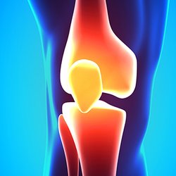 Ocean County Sports Medicine - Dr. Tauro uses a cutting-edge Muscle Sparing, No-Tourniquet Knee Replacement Technique.