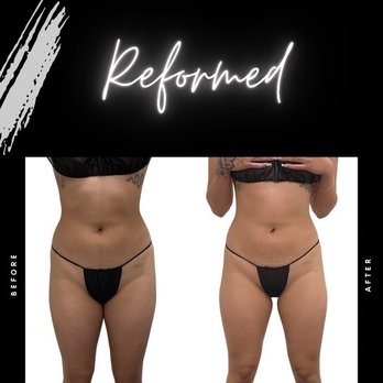 Reformed - Body Contouring Near Me - El Cerrito, California Reformed - Body Contouring Near Me - El Cerrito, California