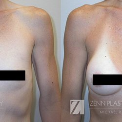 Zenn Plastic Surgery - 36 year old woman underwent breast augmentation with submuscular placement of 225cc gel implants via a periareolar approach.