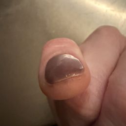 Nails were thick and lumpy Nails were thick and lumpy