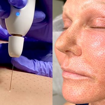 Nue Radiance - Fibroblast uses plasma & sublimation to create an electrical charge, stimulating fibroblast cells, boosting collagen & elastin production. - Skin Care Near Me - Downey, California Nue Radiance - Fibroblast uses plasma & sublimation to create an electrical charge, stimulating fibroblast cells, boosting collagen & elastin production. - Skin Care Near Me - Downey, California