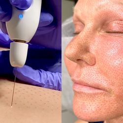 Nue Radiance - Fibroblast uses plasma & sublimation to create an electrical charge, stimulating fibroblast cells, boosting collagen & elastin production.