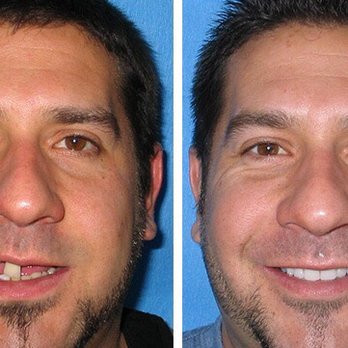Fariborz Farnad, DMD - LE HACE FALTA UNO O ALGUNOS DIENTES?? Vea el resultado de este paciente Implantes dentales solo $75 al mes - Oral Surgeons Near Me - Oxnard, California Fariborz Farnad, DMD - LE HACE FALTA UNO O ALGUNOS DIENTES?? Vea el resultado de este paciente Implantes dentales solo $75 al mes - Oral Surgeons Near Me - Oxnard, California