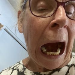 Dental Brothers - An unbecoming photo of me before tooth implant and bridge