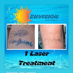 Envision Laser Removal