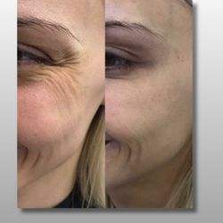 BioLift Med Spa - Jeuveau