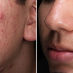 Bloom Medical Group - Acne Removal using IPL and laser, Microdermabrasion and intralesional injections at Bloom Medical Whittier