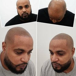 Artisan Scalp Micropigmentation