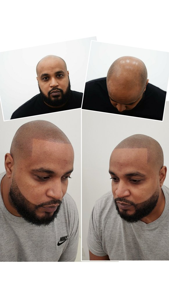 ARTISAN SCALP MICROPIGMENTATION Updated September 2024 Request an