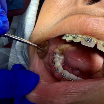 Image Orthodontics - wire shifted and is off the brackets - Orthodontists Near Me - South San Francisco, California Image Orthodontics - wire shifted and is off the brackets - Orthodontists Near Me - South San Francisco, California