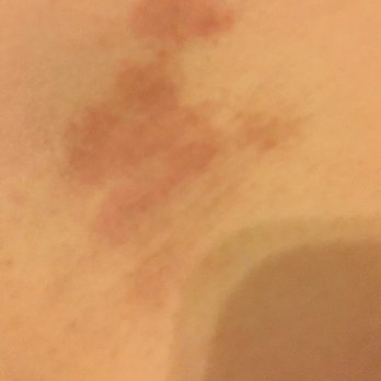 Ann Karen Day Spa - bruise from body scrub - Day Spas Near Me - Arcadia, California Ann Karen Day Spa - bruise from body scrub - Day Spas Near Me - Arcadia, California