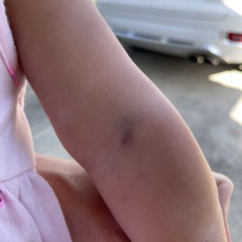 Quest Diagnostics - Blown vein after 2nd attempt on a 1 year old - Laboratory Testing Near Me - Palm Beach Gardens, Florida Quest Diagnostics - Blown vein after 2nd attempt on a 1 year old - Laboratory Testing Near Me - Palm Beach Gardens, Florida