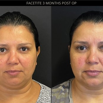 SkinMD - 3 months POST OP FACETITE - Laser Hair Removal Near Me - Boston, Massachusetts SkinMD - 3 months POST OP FACETITE - Laser Hair Removal Near Me - Boston, Massachusetts