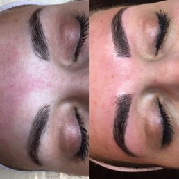 Left: Before Session. Right: After enhancement; 4 weeks after 1st session Left: Before Session. Right: After enhancement; 4 weeks after 1st session