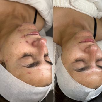 Irene Aesthetics - Acne facial series - Estheticians Near Me - Anaheim, California Irene Aesthetics - Acne facial series - Estheticians Near Me - Anaheim, California