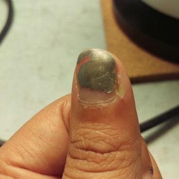 Tipsy - Sorry for the grossness, but infected finger and THREE day old polish. - Nail Salons Near Me - Wellington, Florida Tipsy - Sorry for the grossness, but infected finger and THREE day old polish. - Nail Salons Near Me - Wellington, Florida