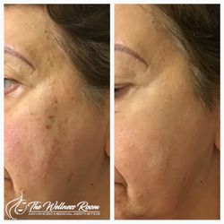 The Wellness Room - BBL&Moxi laser