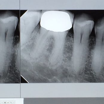 Elite Endodontics - Root canal before - Endodontists Near Me - Honolulu, Hawaii Elite Endodontics - Root canal before - Endodontists Near Me - Honolulu, Hawaii