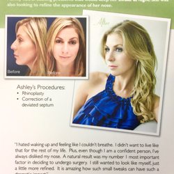 Nathan E Nachlas, MD - Rhinoplasty Before and After Patient