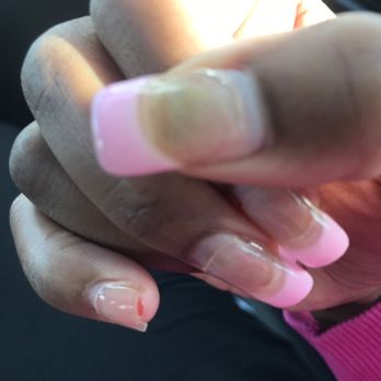 Stone Nails - Bleeding pinky nail with n infected thumb or bruised nail - Nail Salons Near Me - Sacramento, California Stone Nails - Bleeding pinky nail with n infected thumb or bruised nail - Nail Salons Near Me - Sacramento, California
