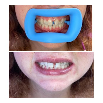 Lash&Body Esthetics By Kiya - Teeth Whitening Session! - Body Contouring Near Me - Middletown, Connecticut Lash&Body Esthetics By Kiya - Teeth Whitening Session! - Body Contouring Near Me - Middletown, Connecticut