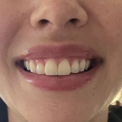 Angeleno Smile - After photo: happy smile!