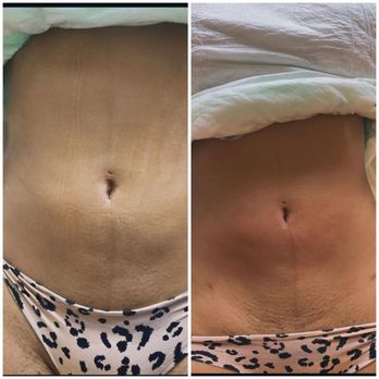 Kurves By Kia - Body Contouring Near Me Kurves By Kia - Body Contouring Near Me