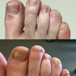 Bay Area Fungal Nail Clinic - Before and after topical medication, 3 laser sessions, and temporary removal of the 4th and 5th toenails