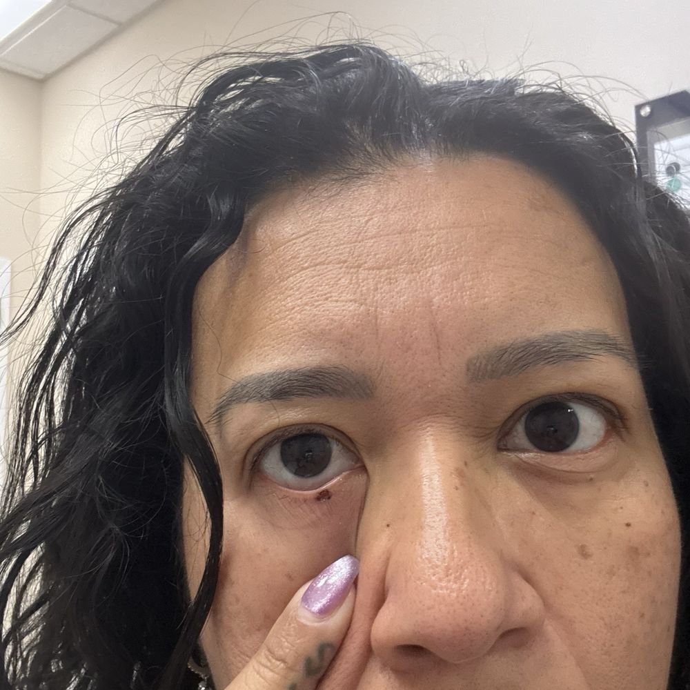 Belaray Dermatology PC - Before removed - Medical Spas Near Me - Hicksville, New York