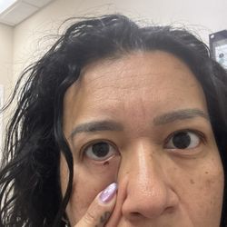 Belaray Dermatology PC - Before removed